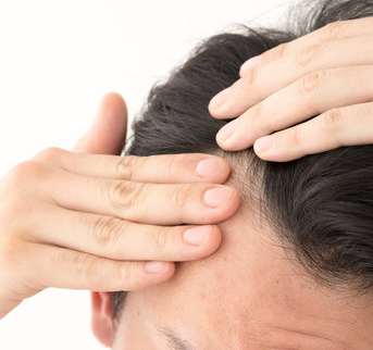 生え際の薄毛を気にする男性