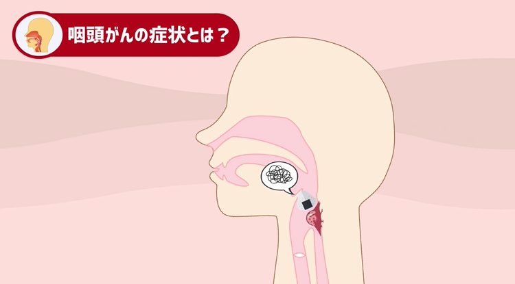 咽頭がんのサブタイプ