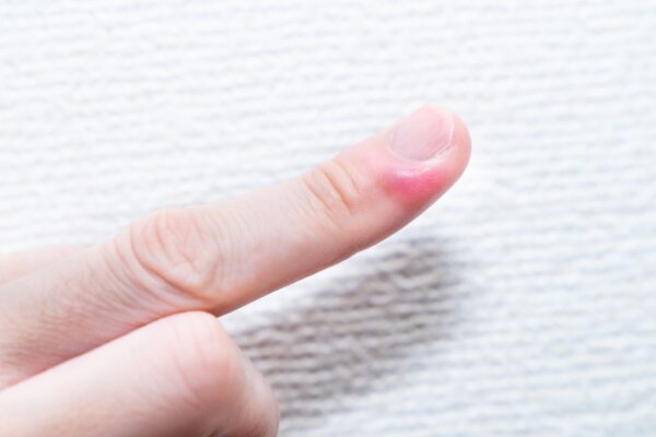 ひょう疽（ひょうそ）の原因・症状・治し方は？指の腫れ・痛みの対策を医師が解説！