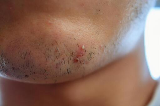 毛包炎(毛嚢炎)とは?ニキビとの違いや市販薬での治し方|陰部や背中のブツブツ対策