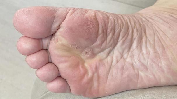 魚の目の治し方!自分で芯を取る方法や薬の種類、皮膚科での除去治療を解説!【医師監修】